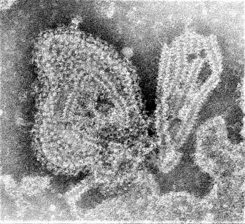 Possible Outbreak Of Mumps Virus Worries Doctors In Kashmir