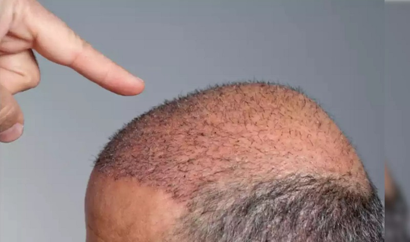 Man Develops Health Issues After Botched Hair Transplant