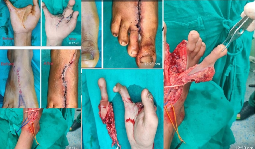 SKIMS Performs Microvascular Toe To Hand Transplant Surgery