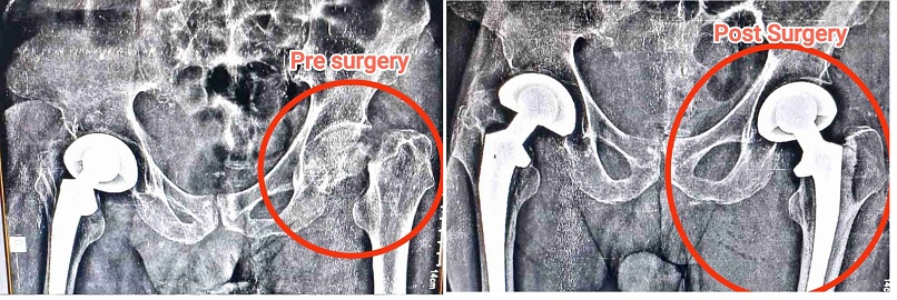 Well Care Medical Institute Performs First Partial Hip Replacement 